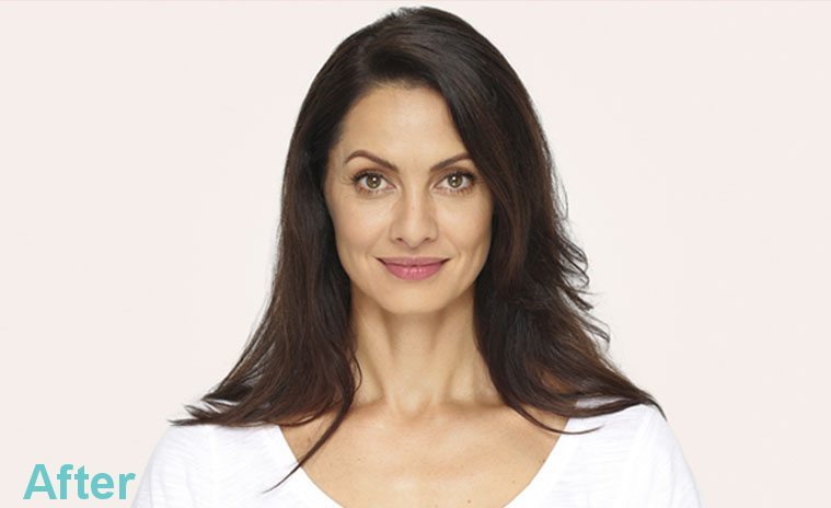 CHEEK ENHANCEMENT TREATMENT RESULTS CHEEK ENHANCEMENT TREATMENT RESULTS