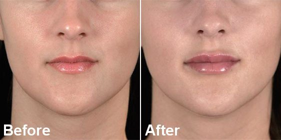 LIP ENHANCEMENT DERMAL FILLER TREATMENT RESULTS LIP ENHANCEMENT DERMAL FILLER TREATMENT RESULTS