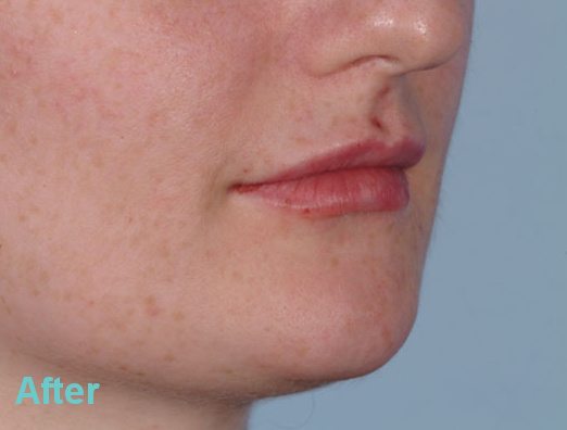 lips after