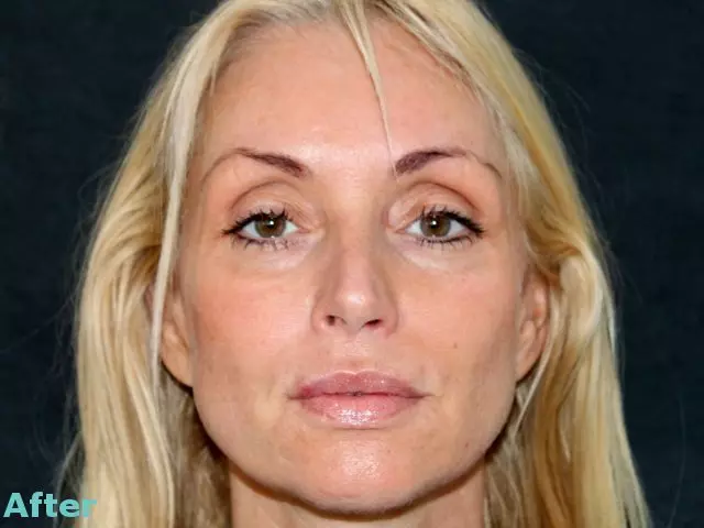 Silhouette Soft Mid Face Lift | Excellence Medical Clinic after