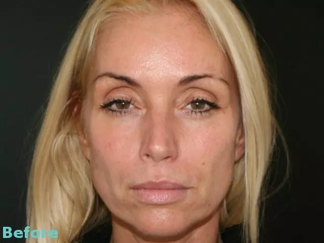 Silhouette Soft Mid Face Lift | Excellence Medical Clinic before
