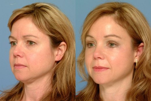 Procedure-for-Brow-Lift-before-and-after3 - Excellence ...