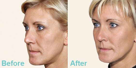DERMAL FILLER EYE TREATMENT RESULTS DERMAL FILLER EYE TREATMENT