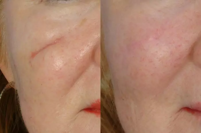 Scar Revision Treatment SCAR REVISION TREATMENT