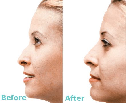 NOSE RESHAPING WITH DERMAL FILLERS