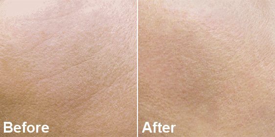 MESOTHERAPY TREATMENT FOR SKIN