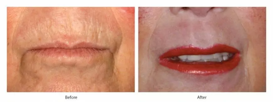 Smokers-Lines-Treament-Before-After upper lip barcode lines treatment-before and after photo