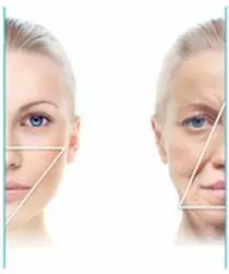 Silhouette Soft Mid Face Lift | Excellence Medical Clinic Silhouette Soft Mid Face Lift