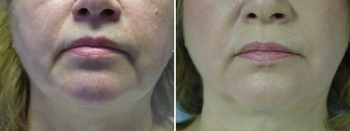 MARIONETTE LINES BOTOX TREATMENT BEFORE & AFTER RESULTS MARIONETTE LINES BOTOX TREATMENT BEFORE & AFTER RESULTS