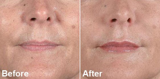 NOSE TO MOUTH LINES BOTOX TREATMENT BEFORE AND AFTER RESULTS NOSE TO MOUTH LINES BOTOX TREATMENT BEFORE AND AFTER RESULTS