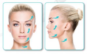 Silhouette Soft thread lift-before and after