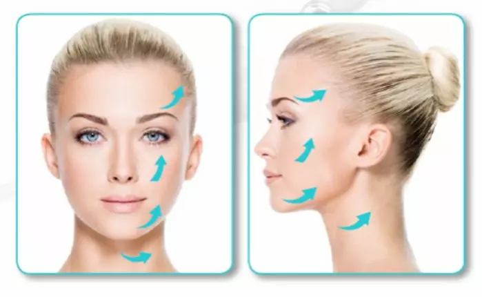 Silhouette Soft Thread Lift-Before And After Silhouette Soft thread lift-before and after