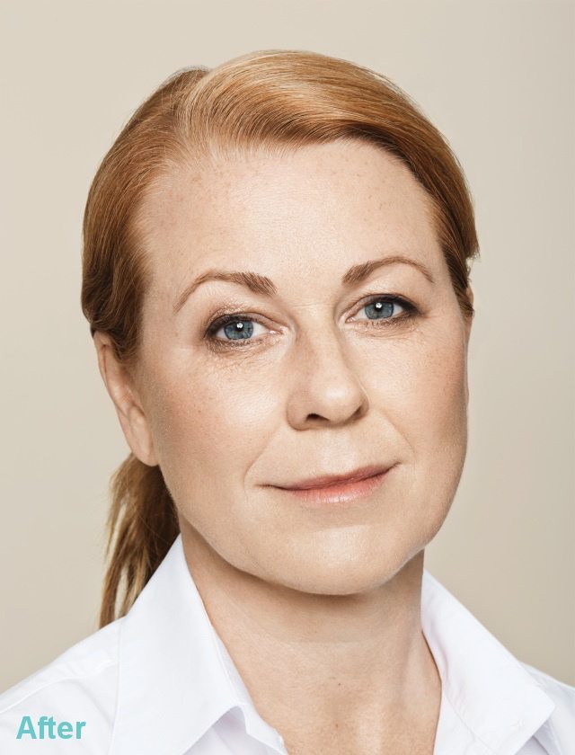 Facial Volume After