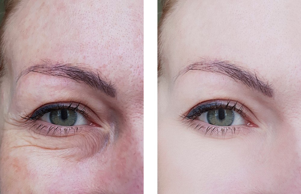 FOREHEAD LINES & FROWN LINES TREATMENT FOREHEAD LINES & FROWN LINES TREATMENT