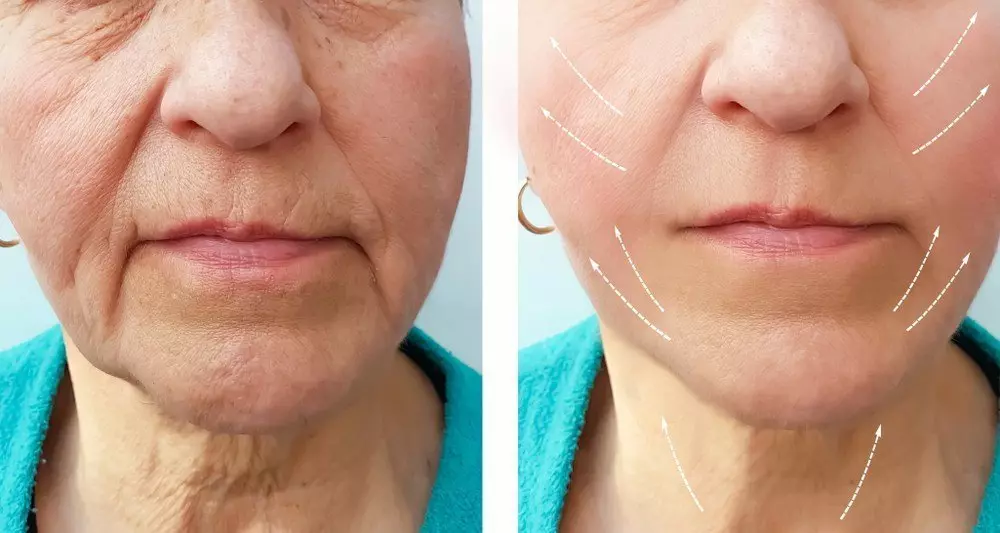 Facial Remodelling For Rounded And Square Shape Face To Gently Elongated Shape | Excellence Medical Clinic Facial remodelling for rounded and square shape face to gently elongated shape