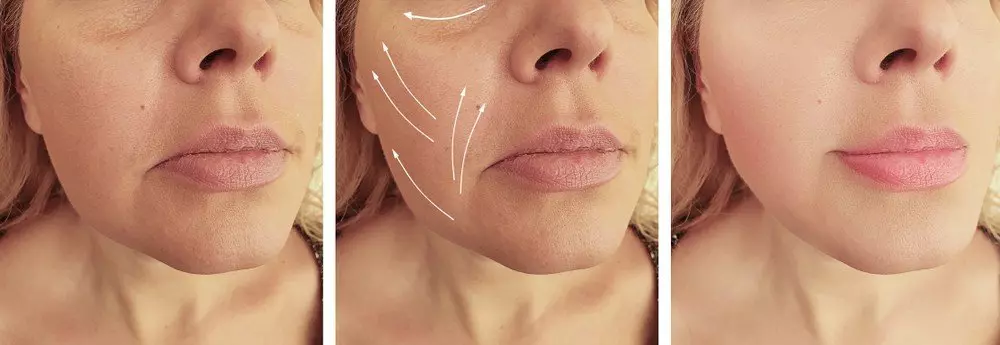Facial Remodelling For Rounded And Square Shape Face To Gently Elongated Shape | Excellence Medical Clinic Facial remodelling for rounded and square shape face to gently elongated shape