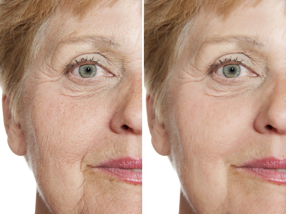 Eye Area Rejuvenation 6