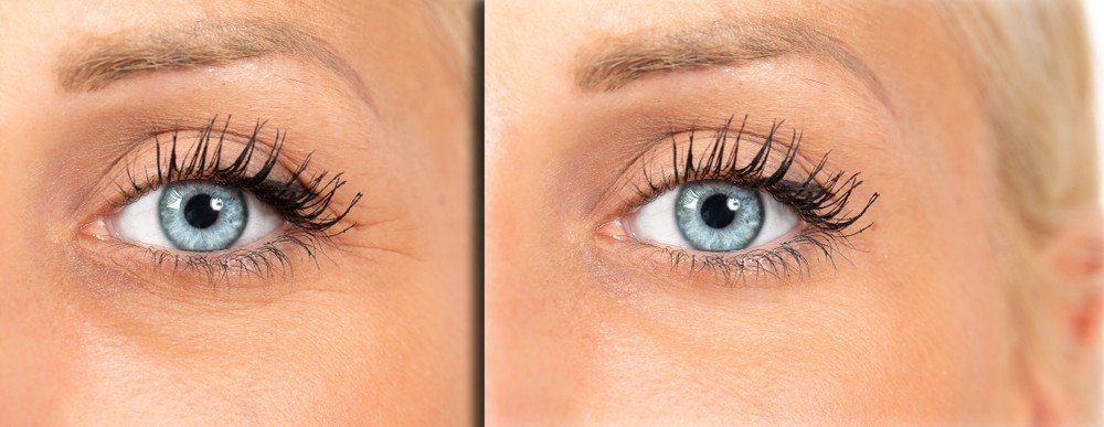 Eye Area Rejuvenation 5