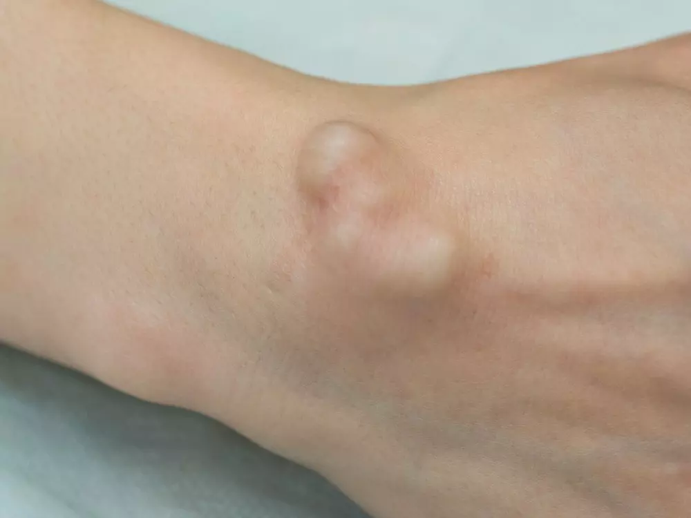 Ganglion-Cyst-On-Left-Wrist Gangion-Cyst-on-left-wrist-for-treatment