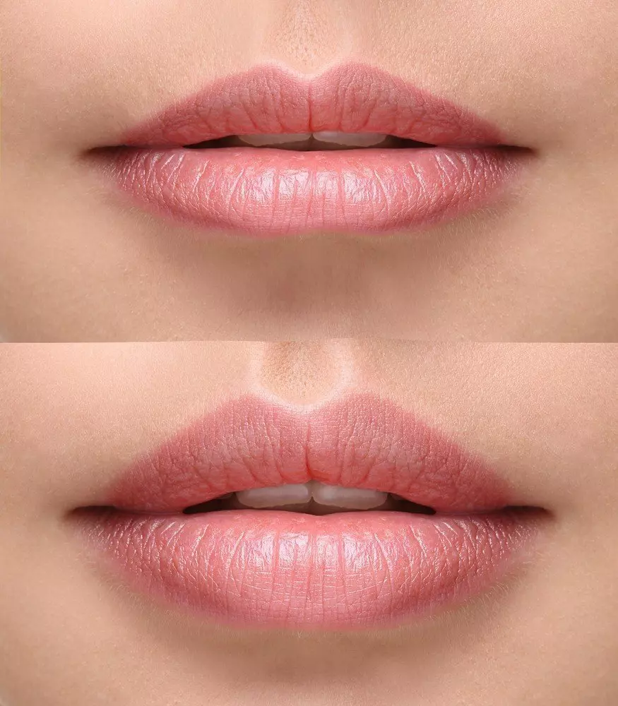 Lip-Rejuvenation-With-Dermal-Filler-Before-And-After-Photo Lip rejuvenation with Dermal Filler- great before and after photo