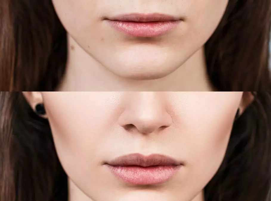 Lip lines and lip treated with dermal filler