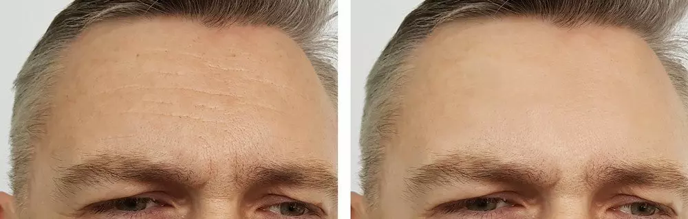 Anti-Wrinkle Treatments | Excellence Medical Clinic Anti-Wrinkle Treatments
