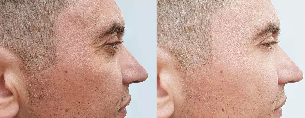 Anti-Wrinkle Treatments | Excellence Medical Clinic Anti-Wrinkle Treatments