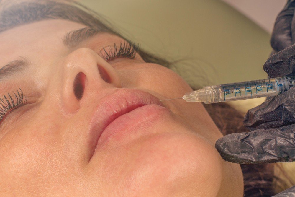 Smokers’ Lines Dermal Filler Treatment | Excellence Medical Clinic Smokers’ Lines Dermal Filler Treatment