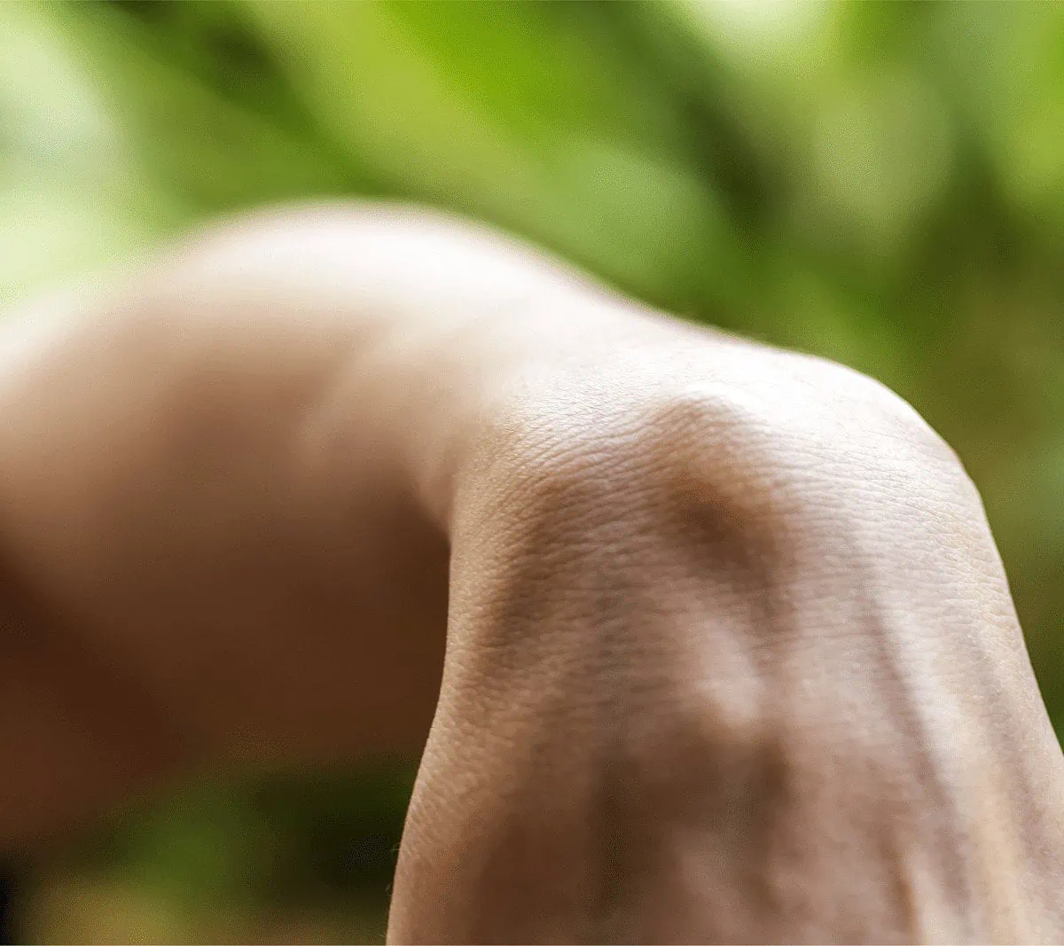 Ganglion Cyst Of Dorsum Of Wrist Ganglion cyst on dorsum of wrist