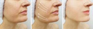 Lifting of saggy skin