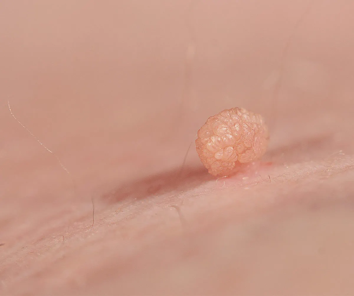 Skin Tag Removal Treatment | Excellence Medical Clinic Skin Tag Removal Treatment