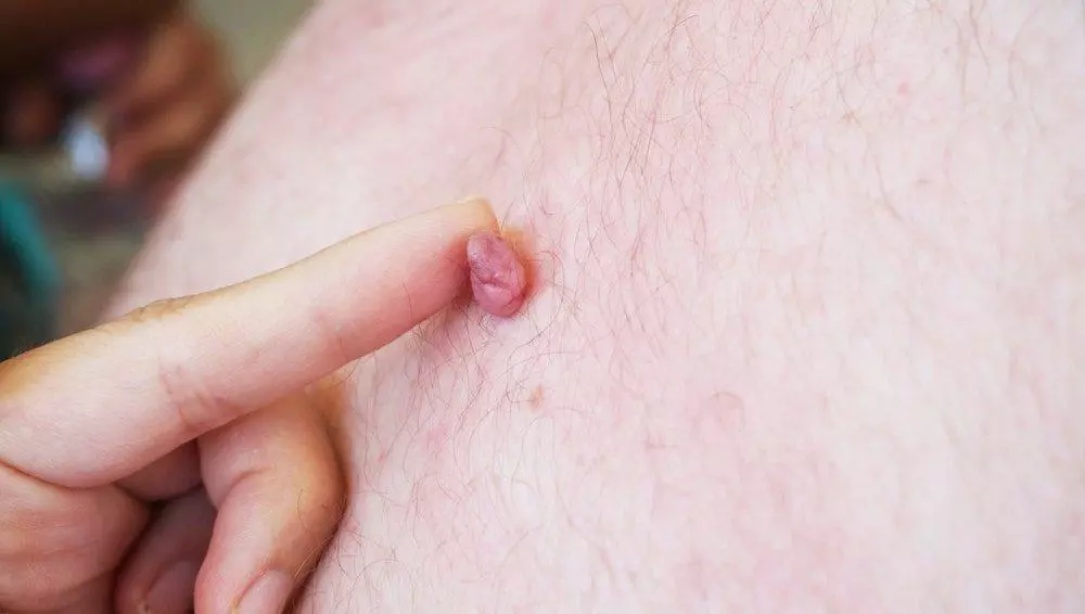 Skin Tag Removal Treatment | Excellence Medical Clinic Skin Tag Removal Treatment